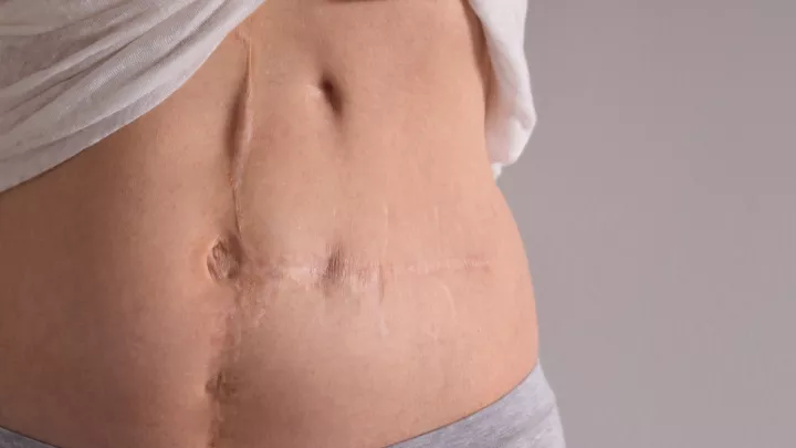 Woman's abdomen with scars